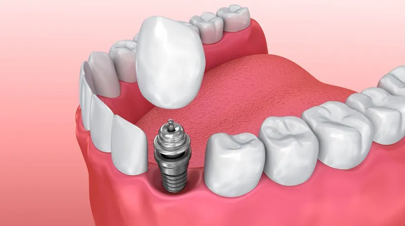 dental implants sample