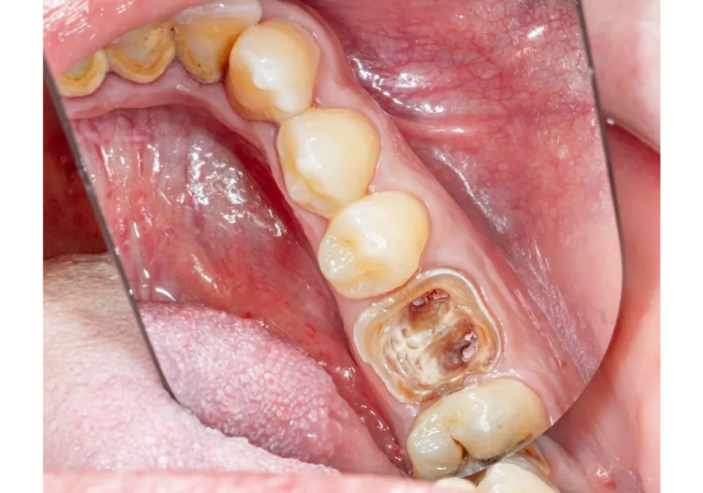 dentist mirror showing rotten tooth