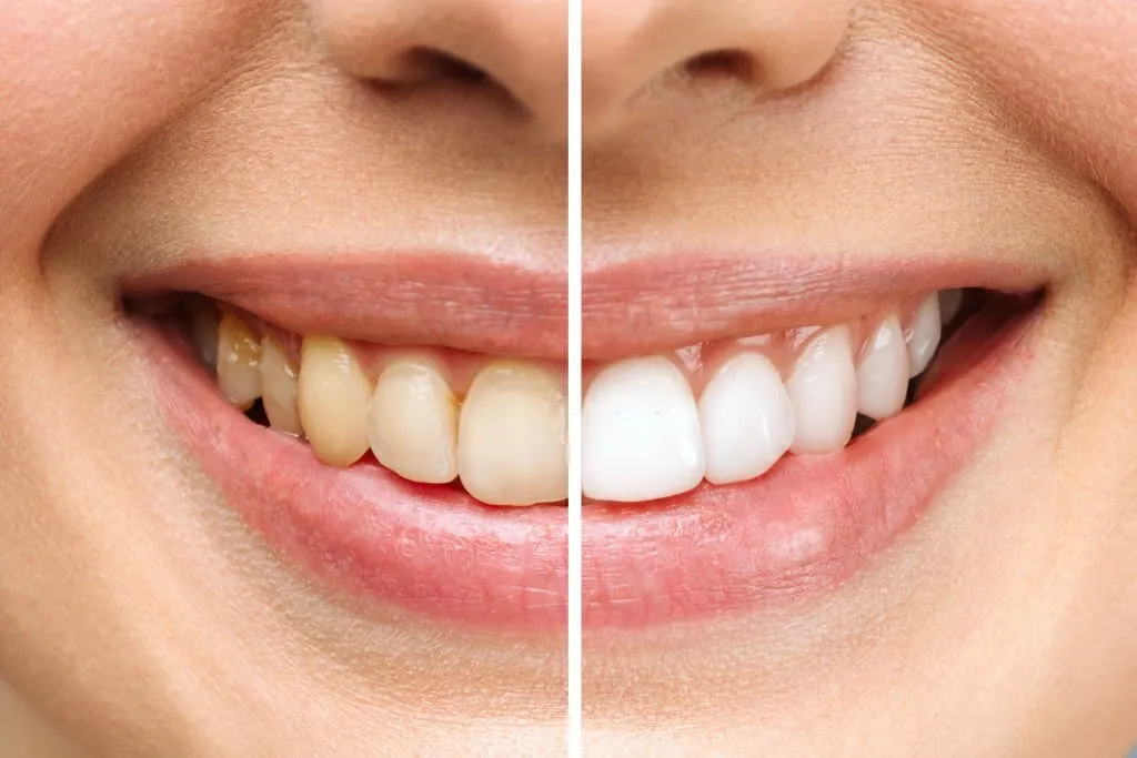 Teeth Whitening before and after