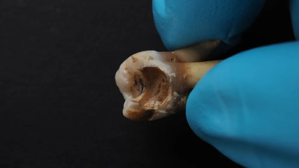 dentist holding rotten tooth