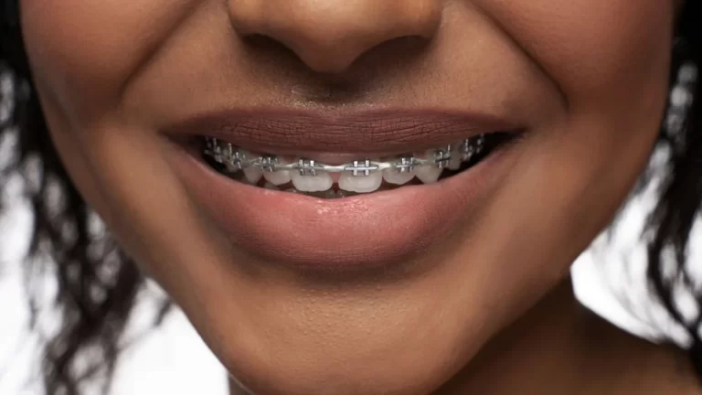 woman showing her braces