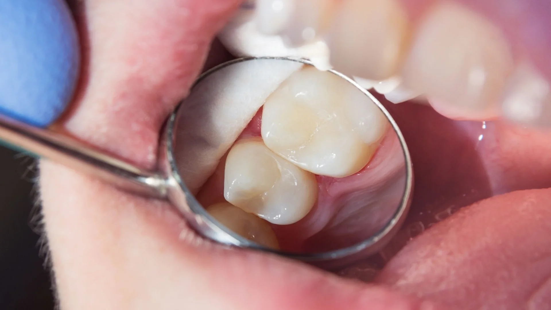 checking teeth with a dental mirror